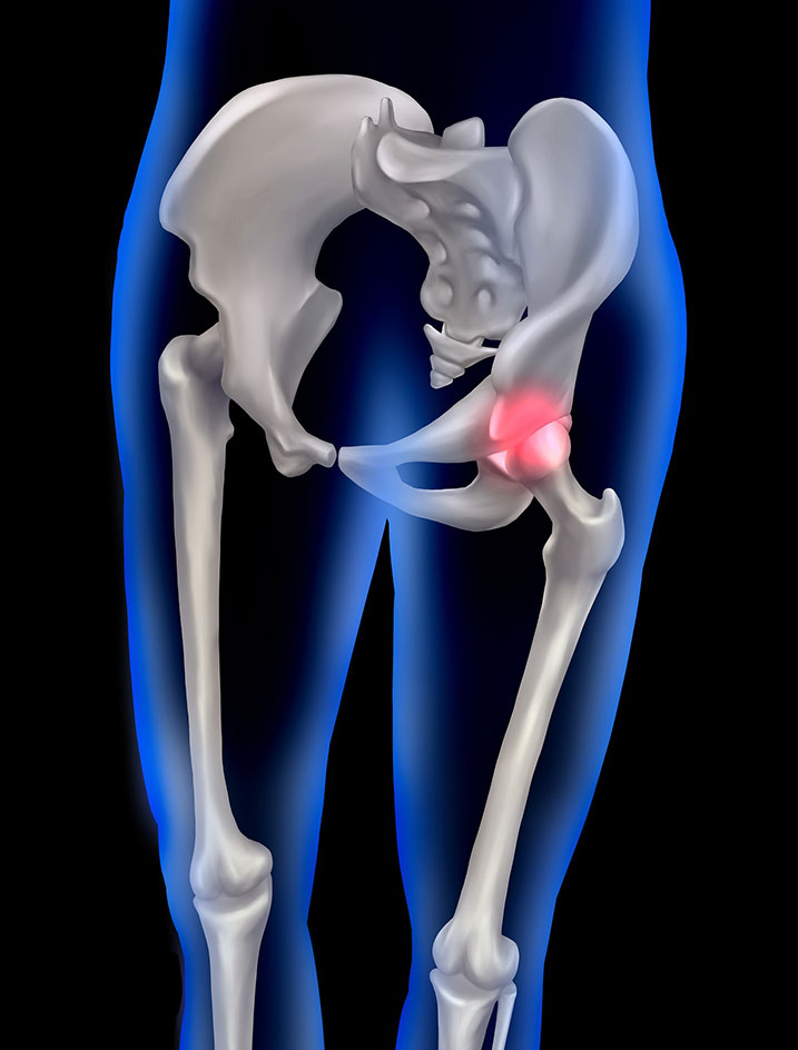 Minimally Invasive Hip Replacement Surgery