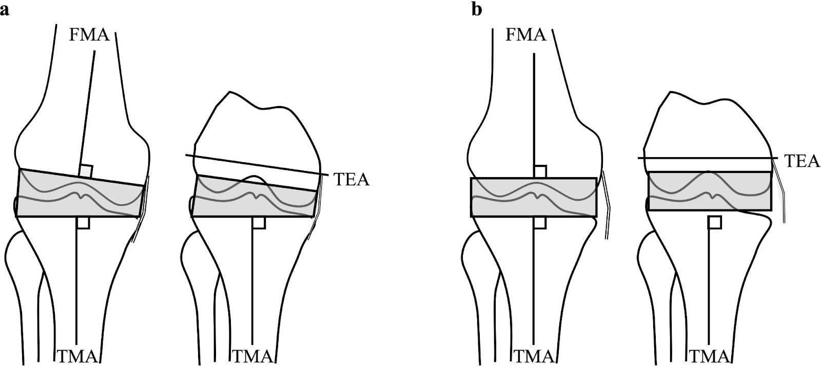 Kinematic Alignment in Knee Replacement: Restoring Your Natural Motion