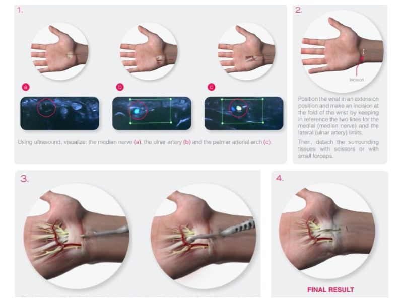 Steps of the Ultra-sound guided Carpal Tunnel Decompression Surgery