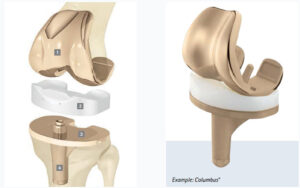 The Columbus Knee System: Advanced Total Knee Replacement for Long-Term Results