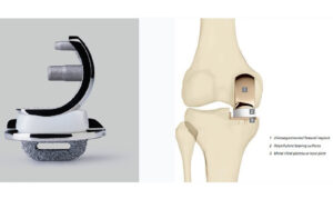 The Oxford Partial Knee Replacement System: A Breakthrough in Knee Arthritis Treatment