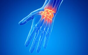 The four stages of carpal tunnel syndrome and when to seek treatment