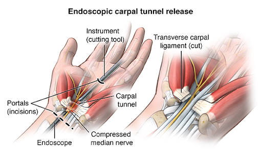 Endoscopic carpal tunnel release