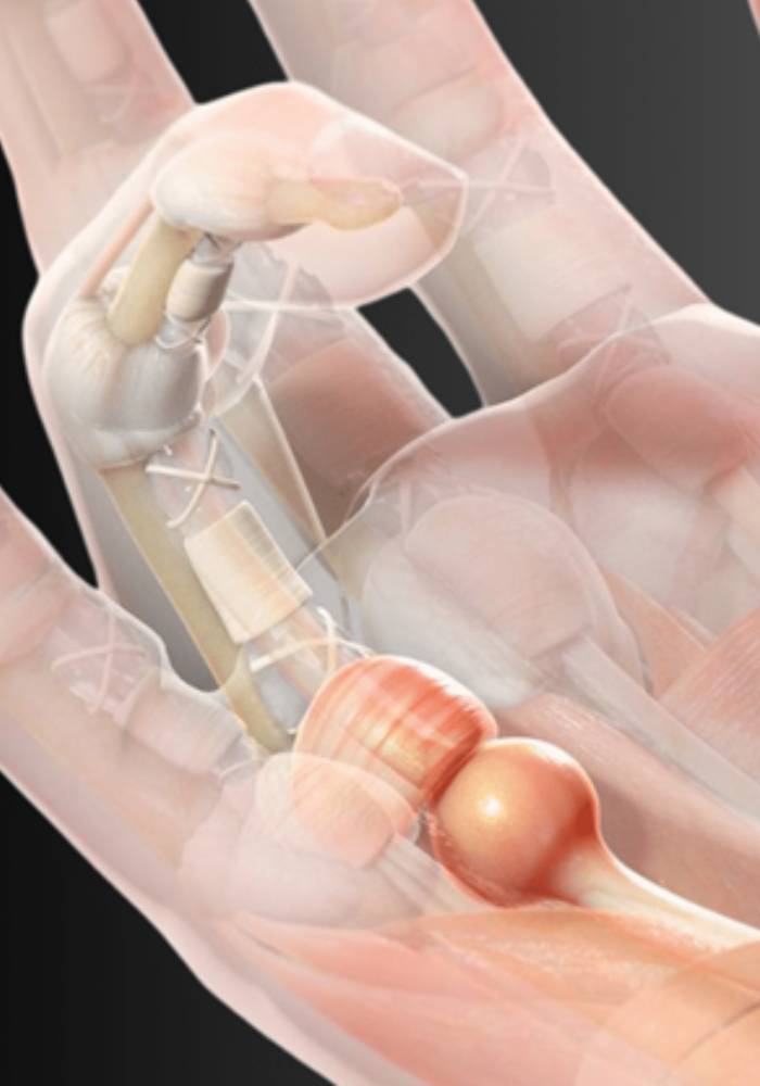 ACL repair and reconstruction surgery London