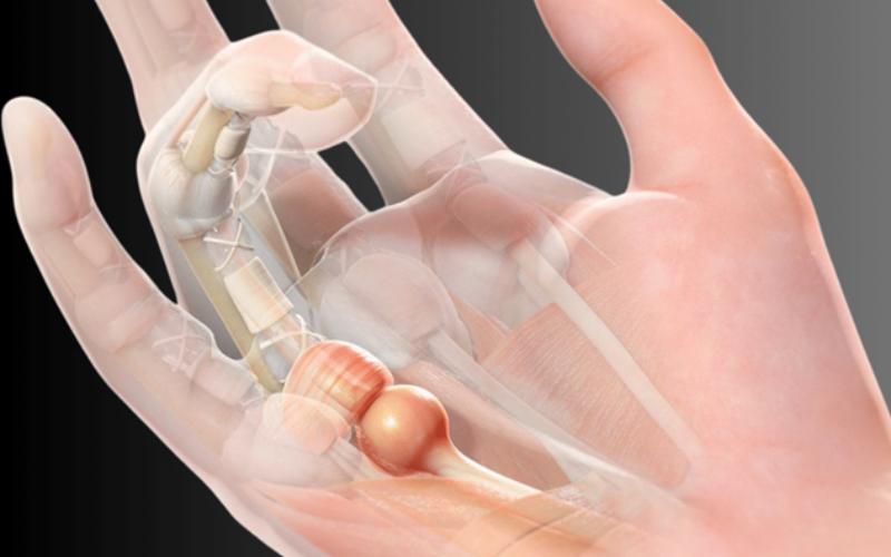 ultrasound guided release trigger finger surgery