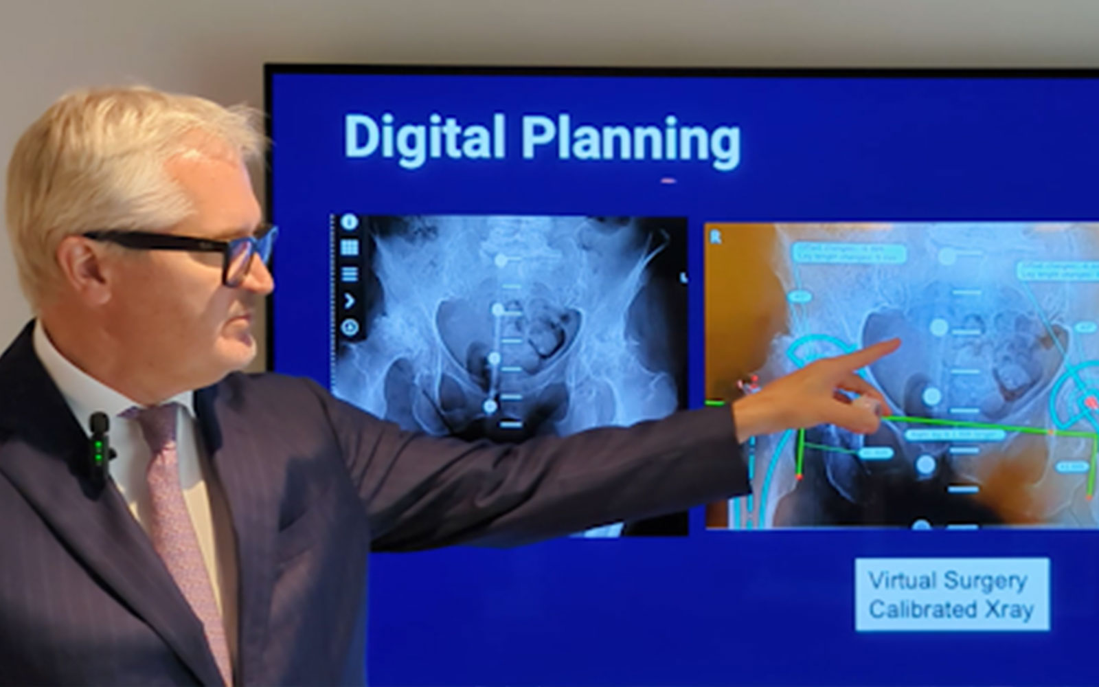 Robotic-Assisted vs Manual Hip Replacement: Is the Technology Worth It?