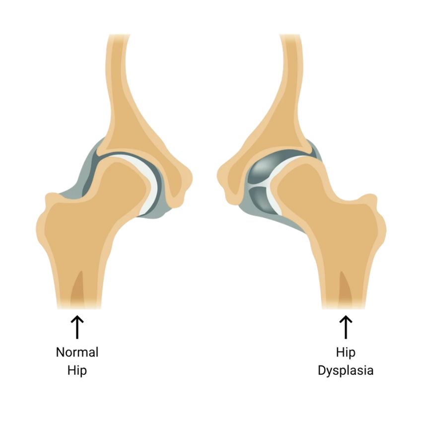 Hip dysplasia anatomy