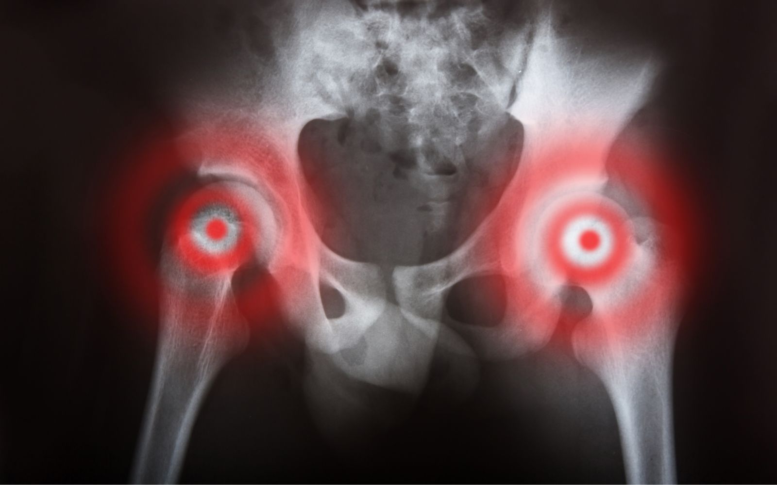 Double Hip Replacement Cost: Both Hips at Once – What Does it Cost and is it Worth it?