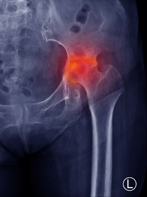 Avascular Necrosis of the Hip (Osteonecrosis or AVN) symptoms and treatment